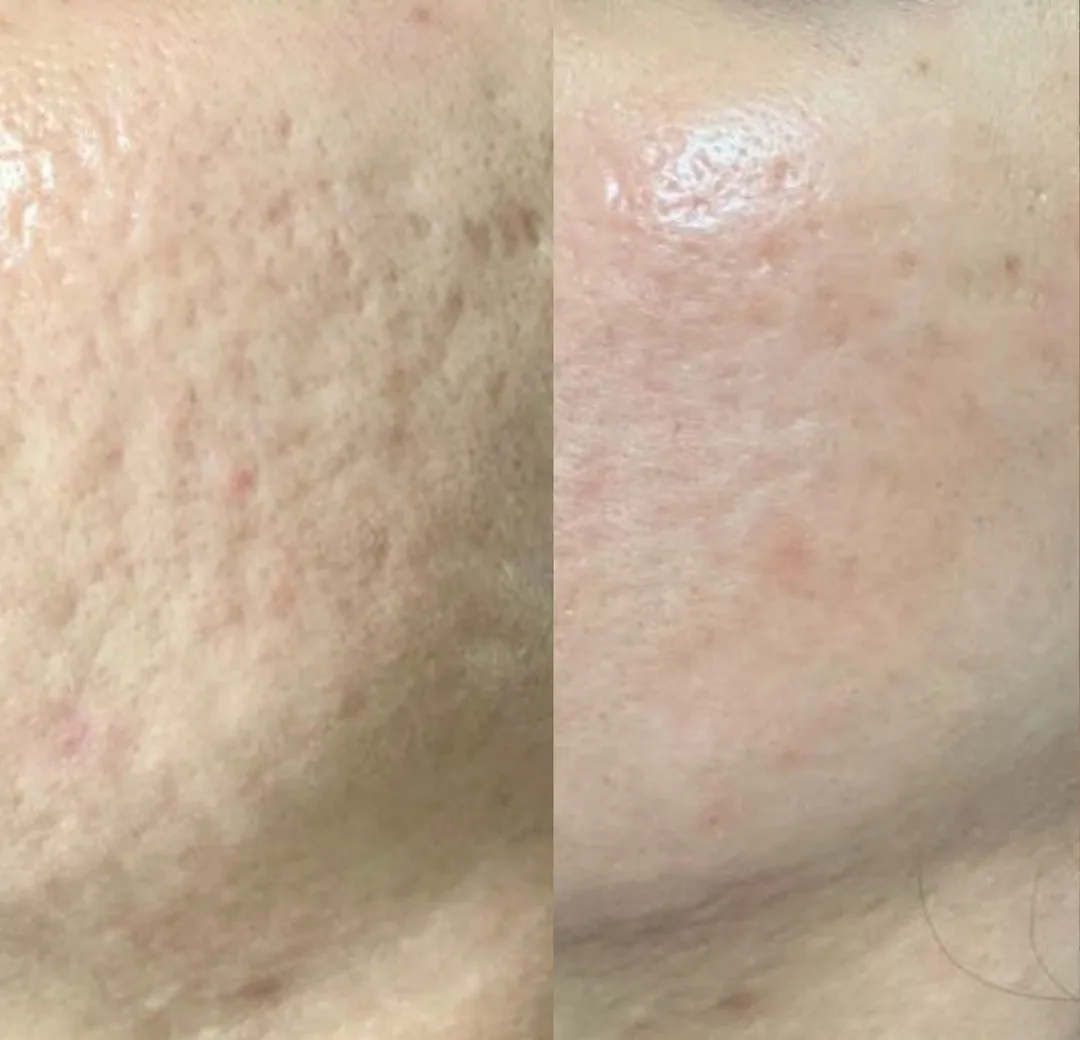 Microneedling for acne scarring before and after