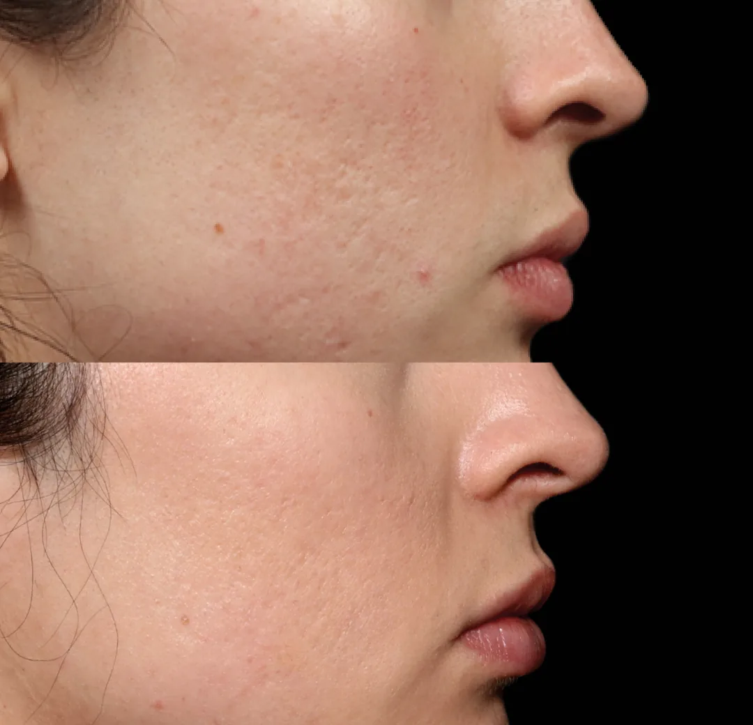 BTL Exion fractional RF before and after, acne scarring and texture