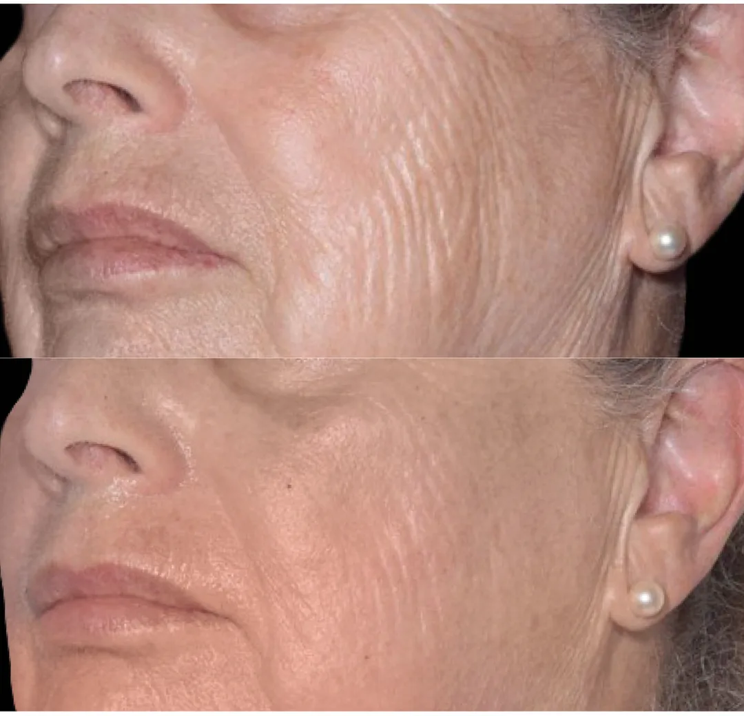 BTL Exion fractional RF before and after, fine lines and crepey skin