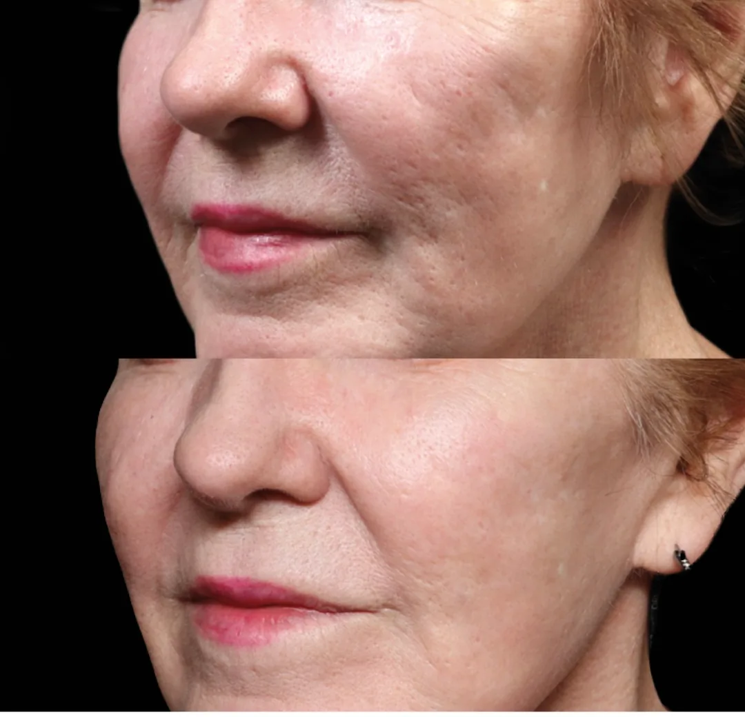 BTL Exion fractional RF before and after, acne scarring and firmness