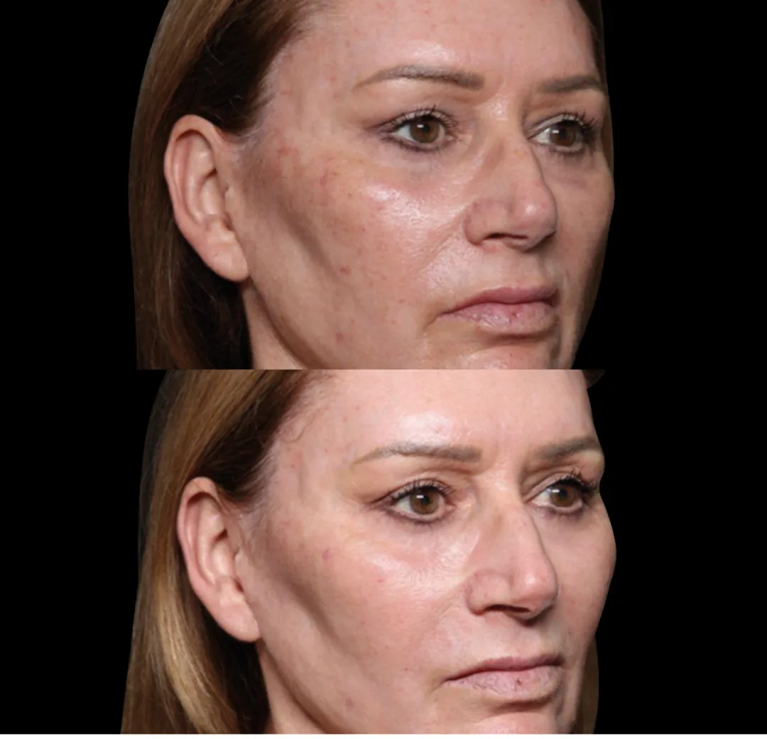 BTL Exion fractional RF before and after, uneven tone and texture