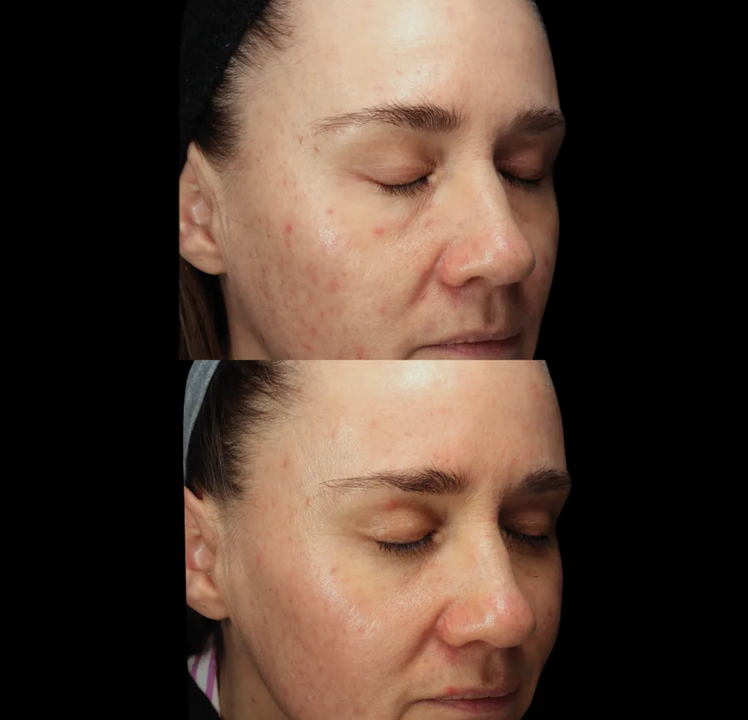 BTL Exion fractional RF before and after, congested uneven skin