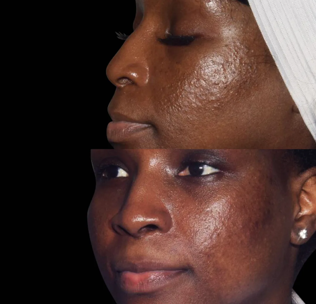 BTL Exion fractional RF before and after, acne scarring on deeper skin