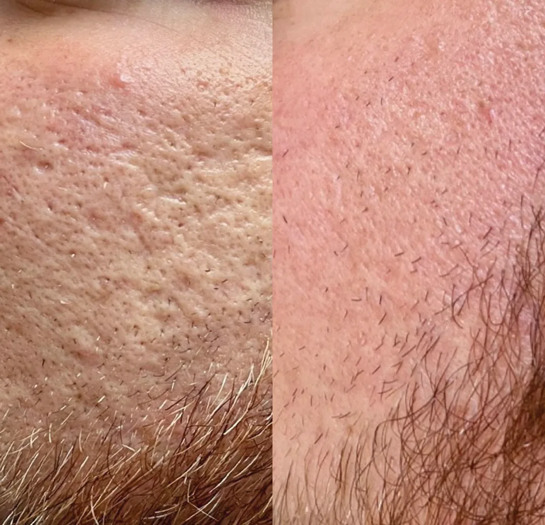 BTL Exion fractional RF before and after, pitted acne scarring