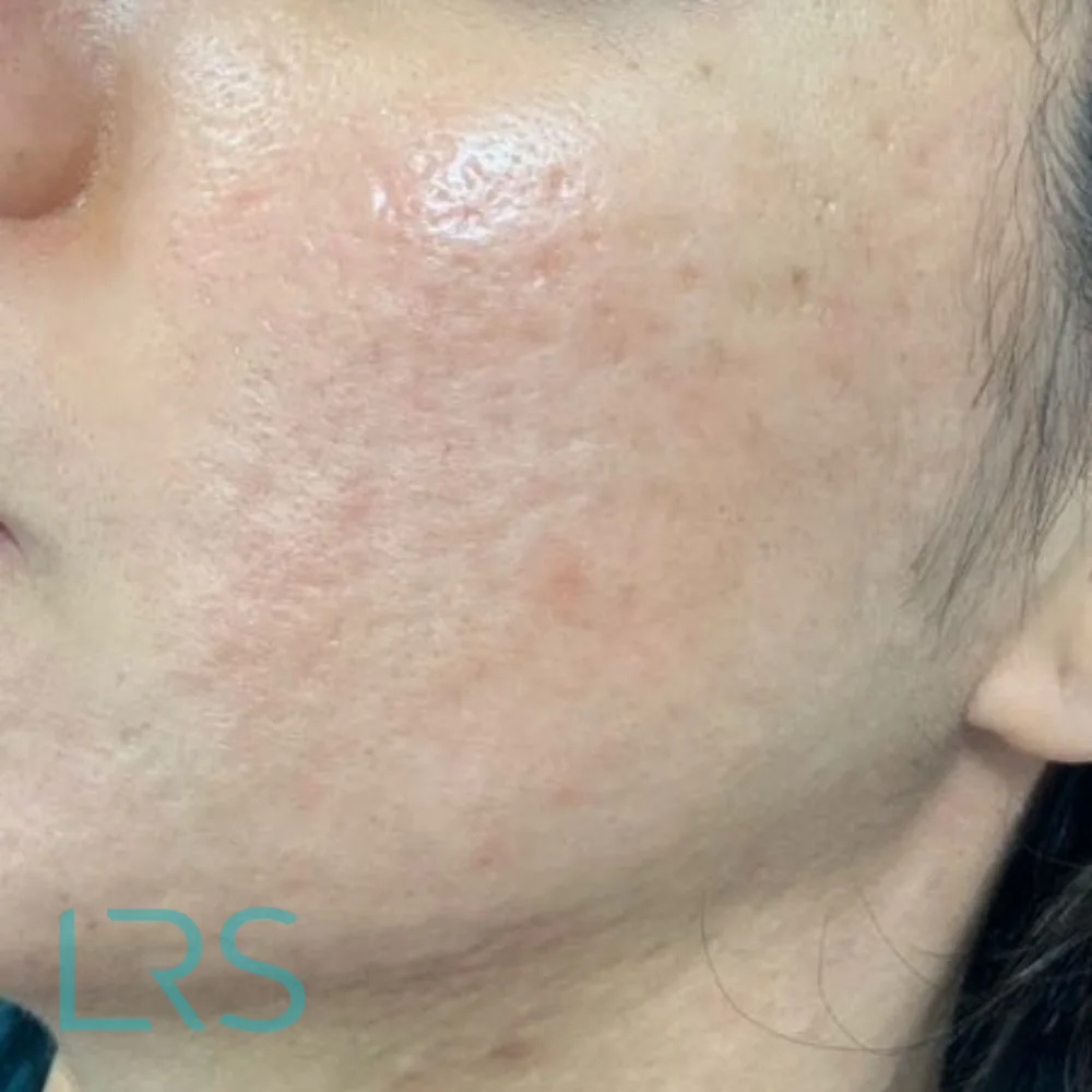 Skin after microneedling at London Real Skin
