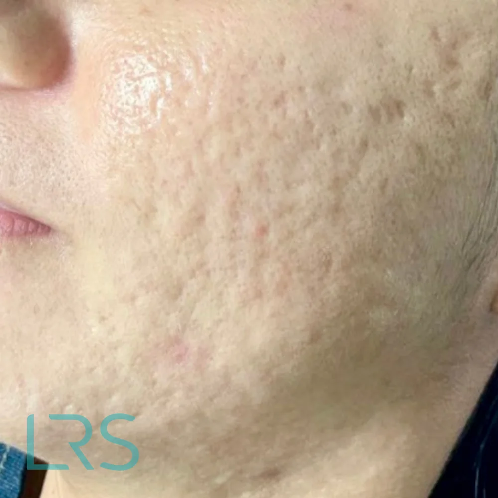 Skin before microneedling