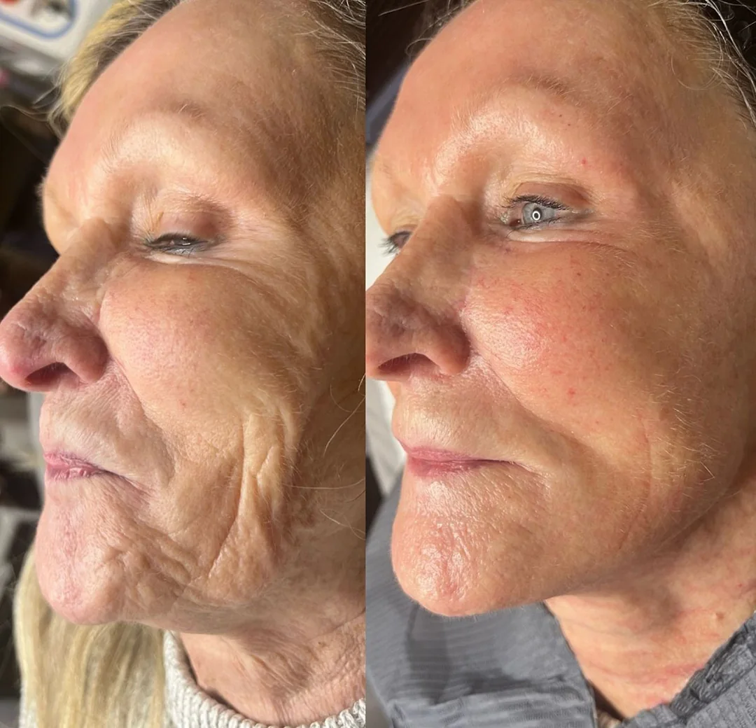 SkinXcell RF microneedling before and after