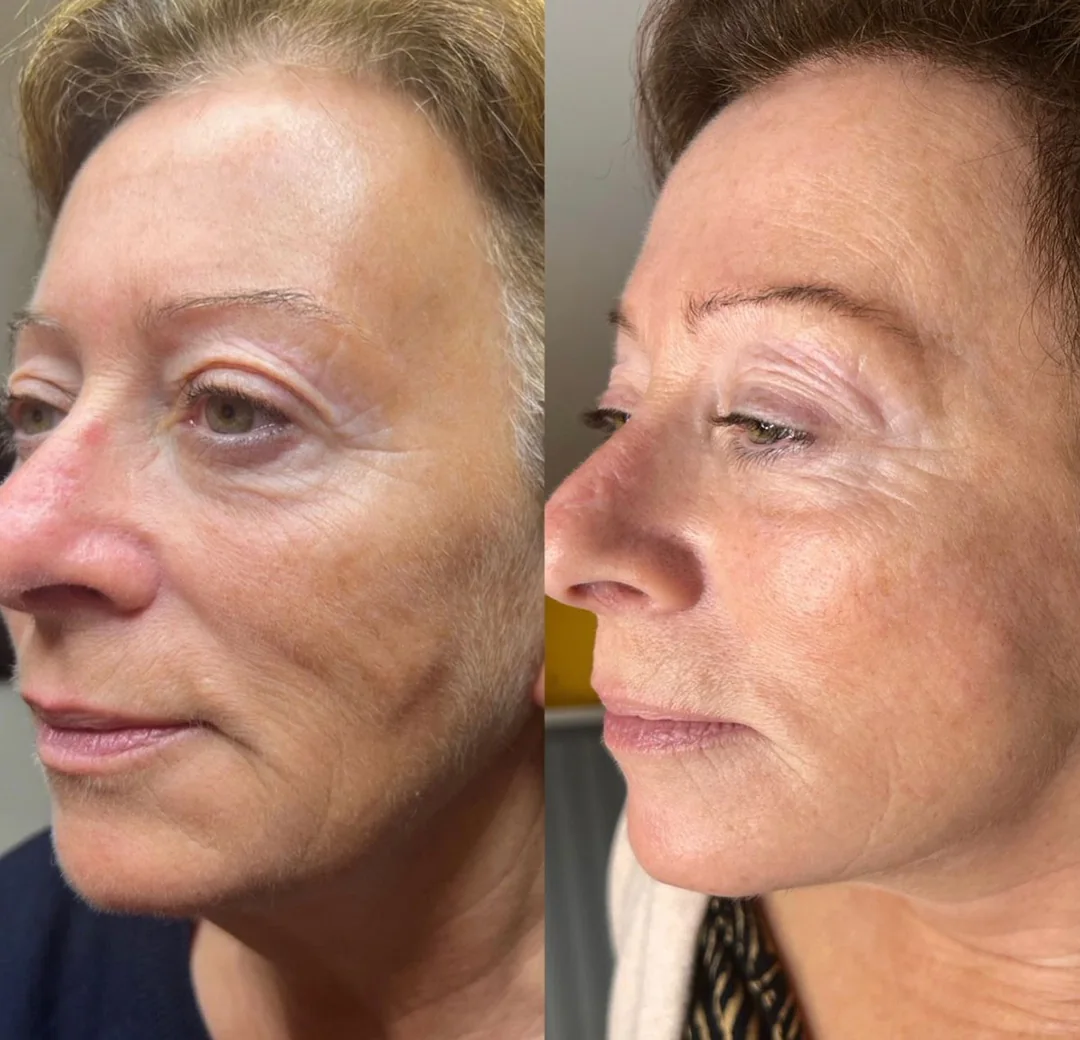 SkinXcell RF microneedling before and after