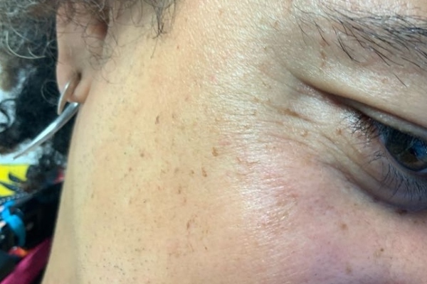 Skin after skin tag removal at London Real Skin