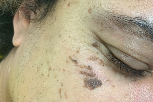 Skin before skin tag removal