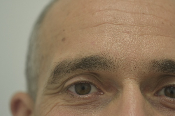 Skin after cherry angioma removal