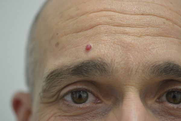 Cherry angioma before treatment