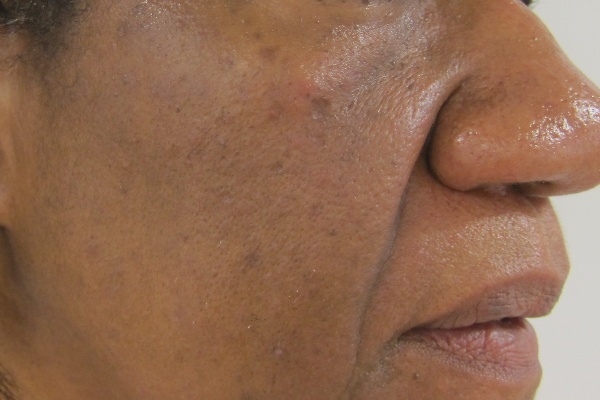 Skin after dermatosis papulosa nigra removal