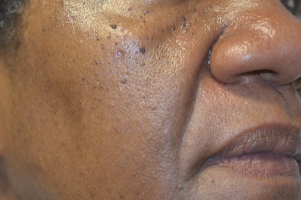 Dermatosis papulosa nigra before treatment