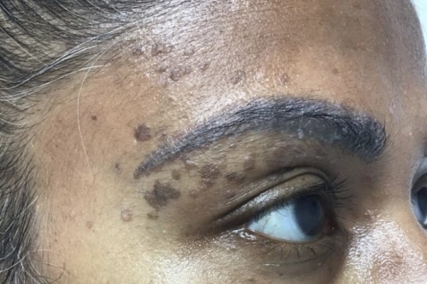 Skin after seborrhoeic keratosis removal