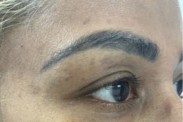 Seborrhoeic keratosis before treatment